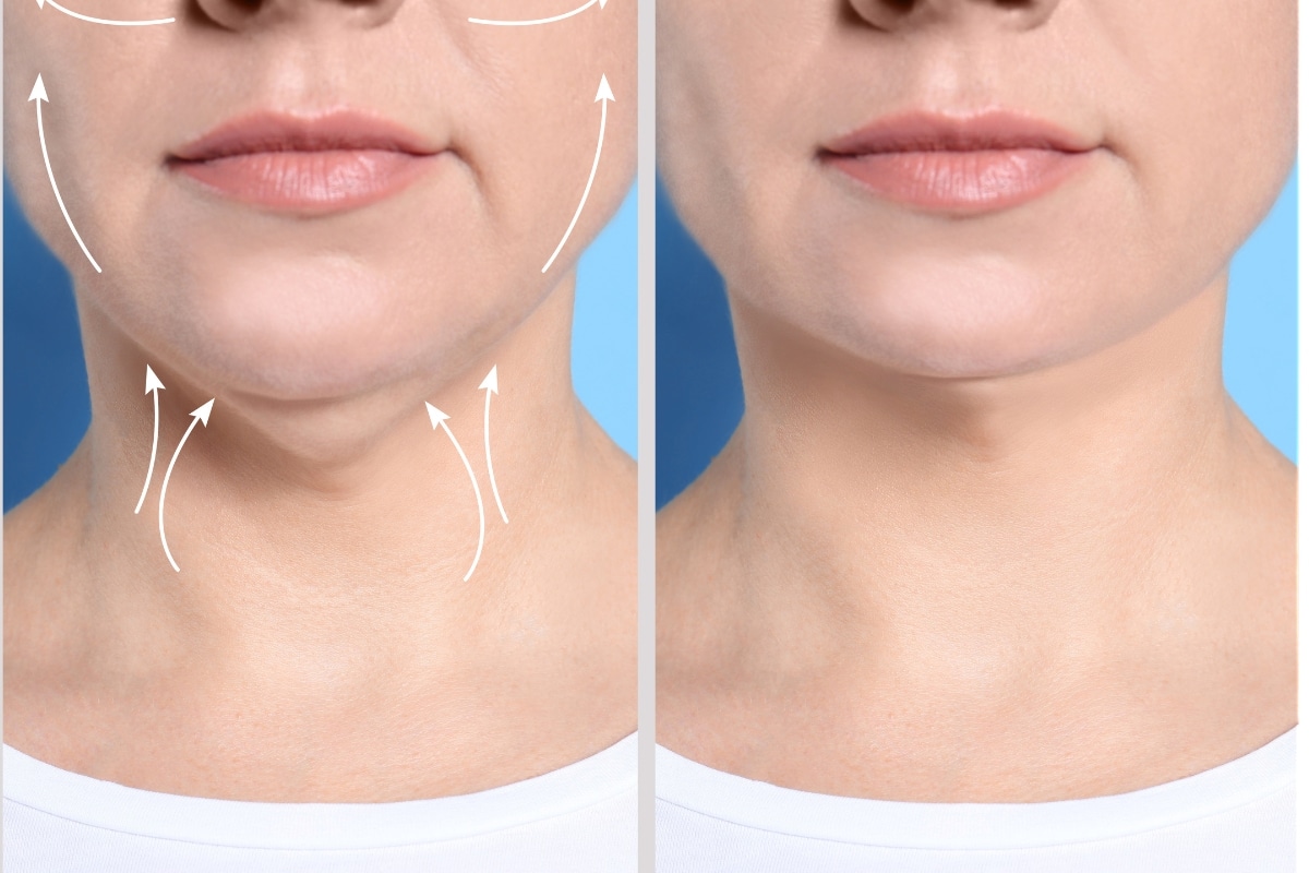 Double Chin The Skinny on Neck Fat