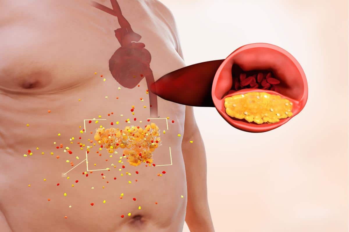 Visceral Fat: