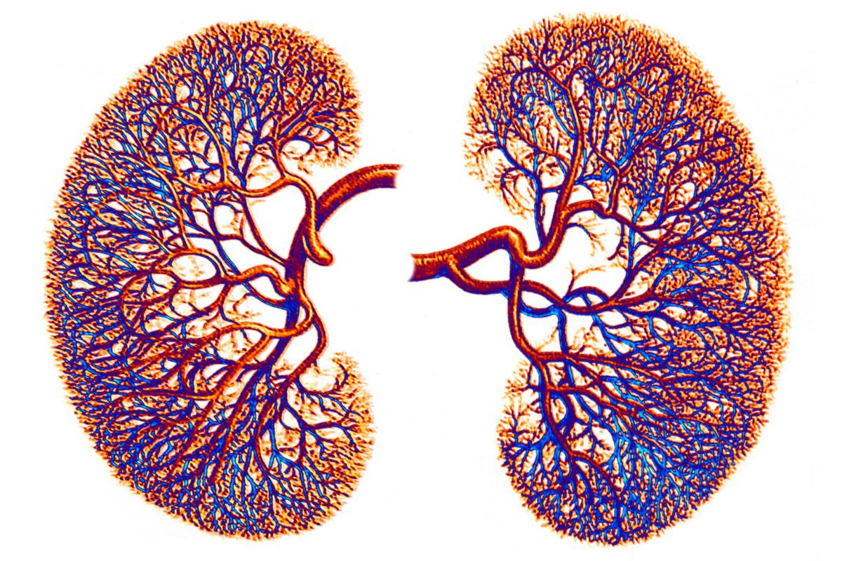 Understanding Chronic Kidney Disease